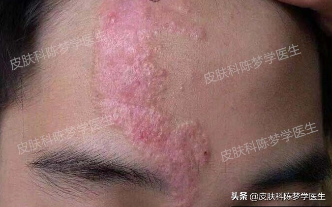 褐青色痣斑吃什么中药好,如何治疗脸上褐青色痣样斑