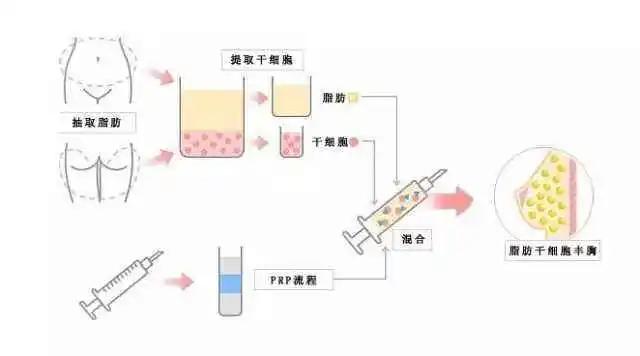 自体脂肪隆胸两年后的忠告,平胸可以做自体脂肪隆胸吗