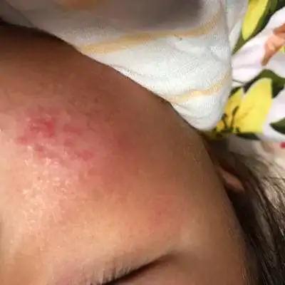 夏季宝宝湿疹高发，爸妈学会这几招，轻松应对宝宝湿疹
