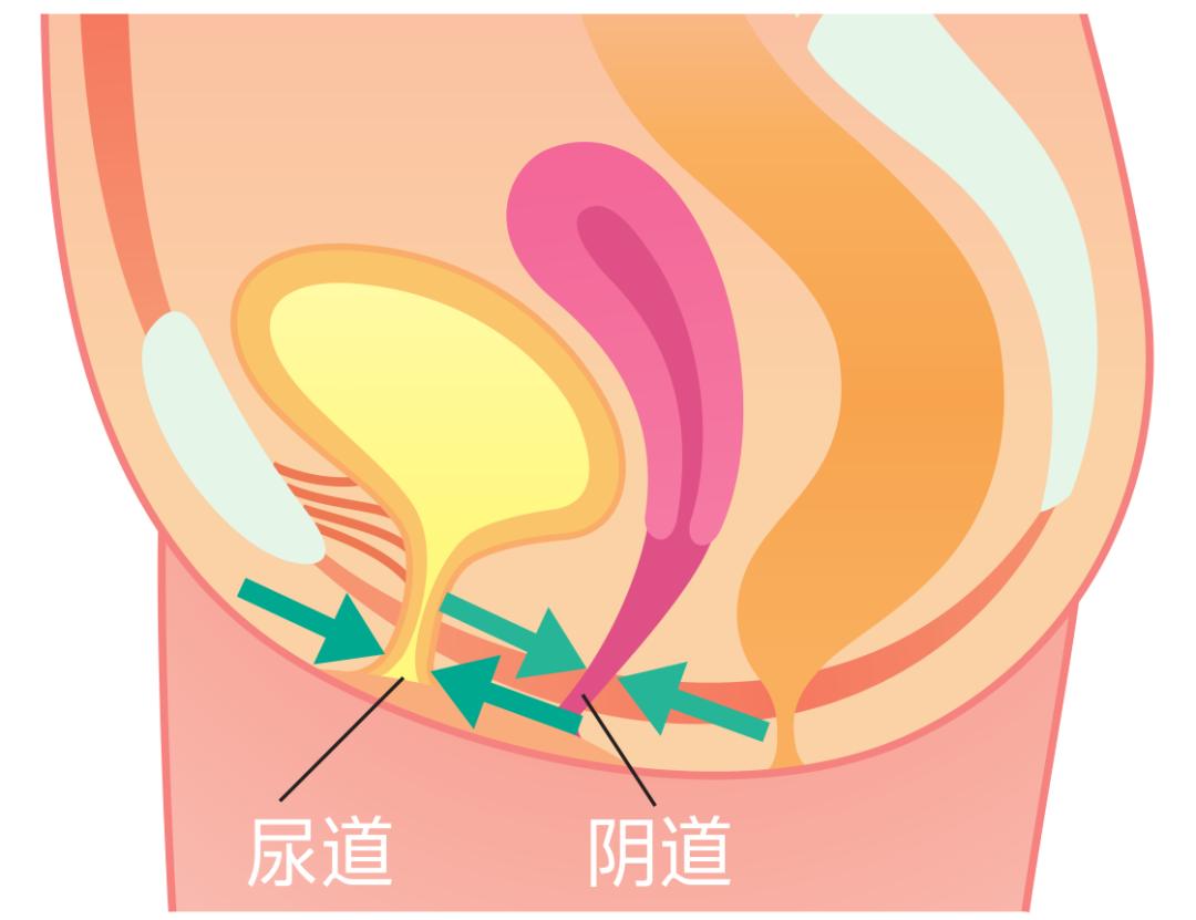 盆底肌训练器材可以改善漏尿吗,改善盆底肌漏尿