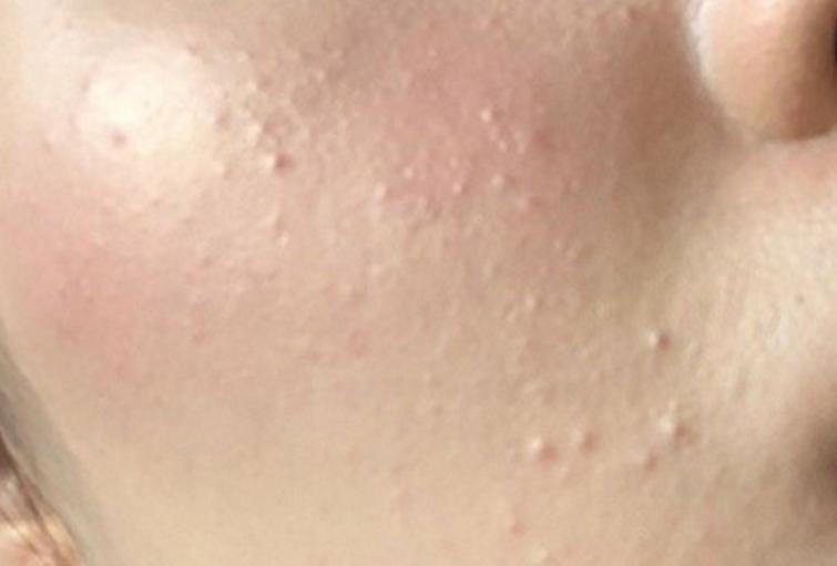 脸上长闭口怎么办用什么方法消除,脸上长闭口该怎么消除