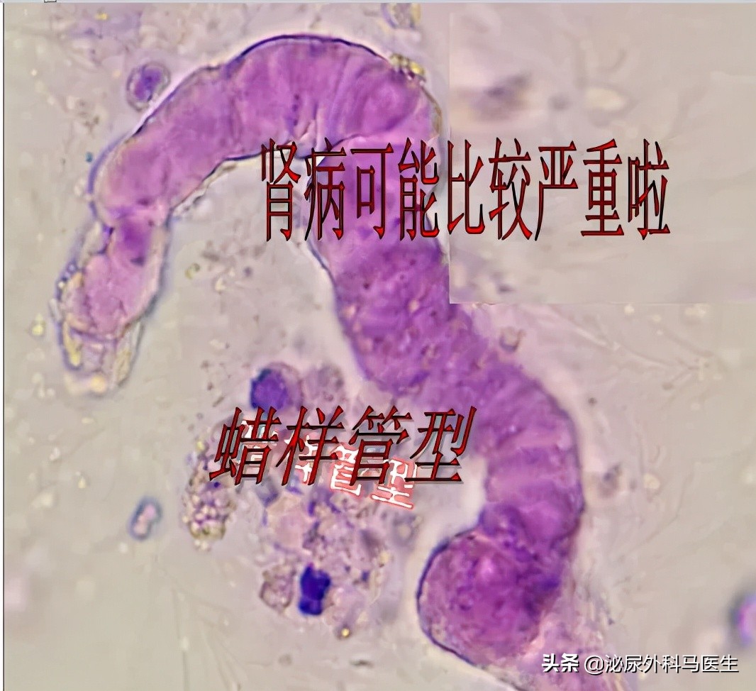 尿液里会有固体吗,尿液里会有沉淀物吗