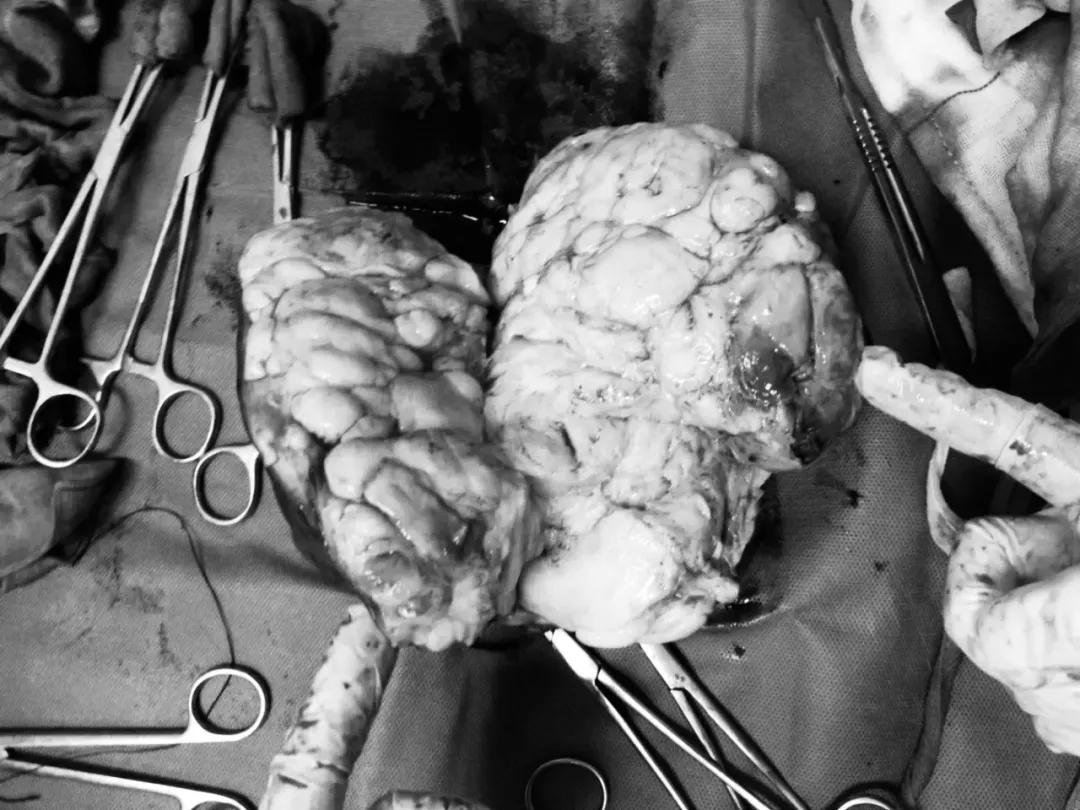 肚子大以为是胖却患肿瘤,以为自己胖其实是囊肿