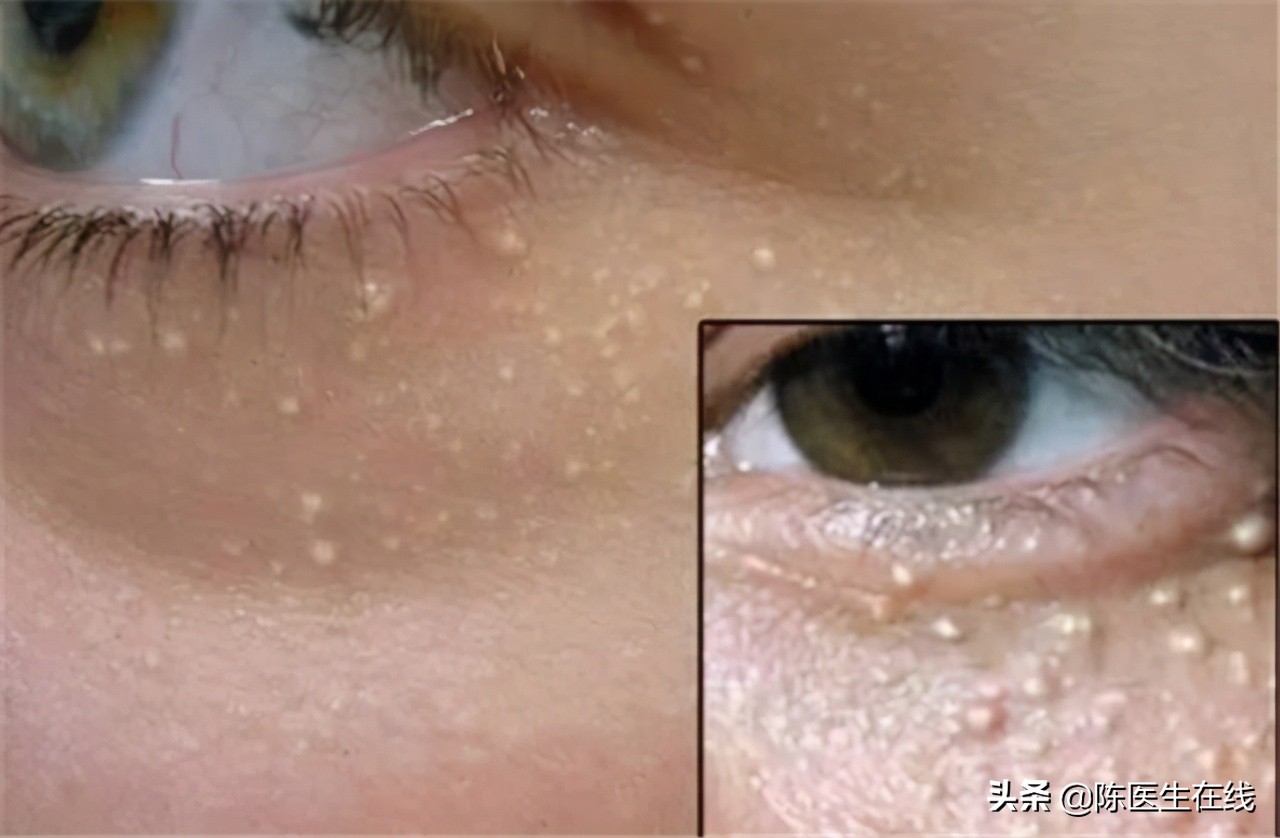 脂肪粒被挑破后会复发吗,脂肪粒割掉了还会再复发吗