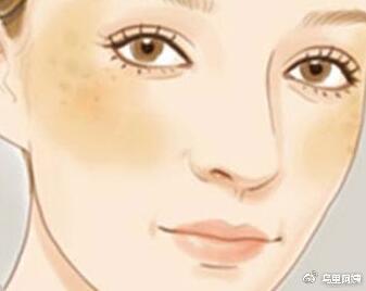 雀斑、*褐斑黄**、咖啡斑、晒斑、妊娠斑...分不清还谈什么祛斑