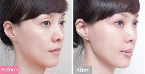 不建议做双眼皮的三种情况,为什么不建议做双眼皮