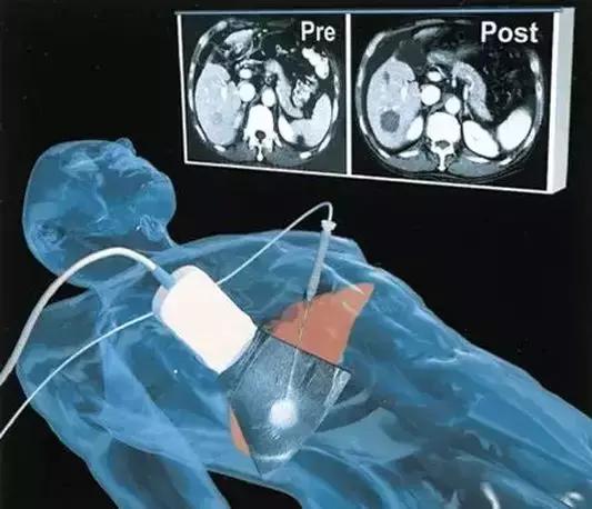 晚期癌症怎么能治,治疗癌症肿瘤的方式都有哪些