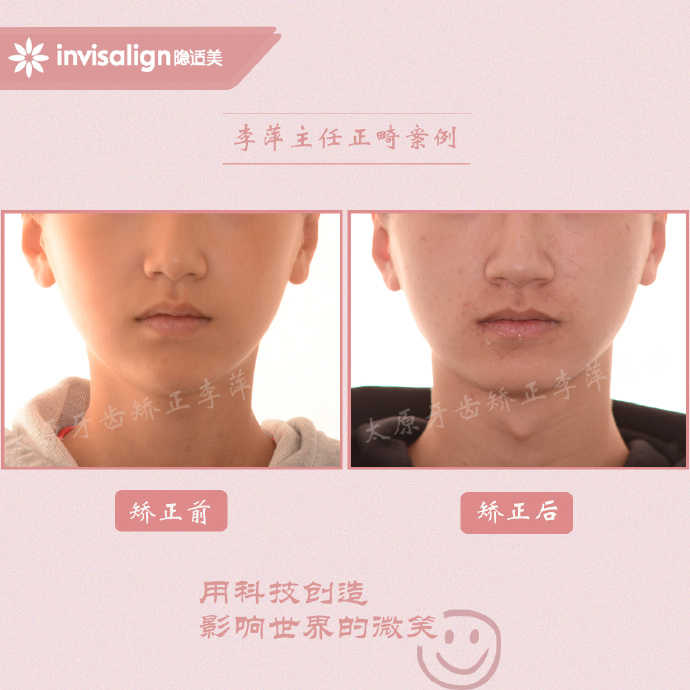 山西太原牙齿矫正医院十大排名,太原市牙齿矫正成功案