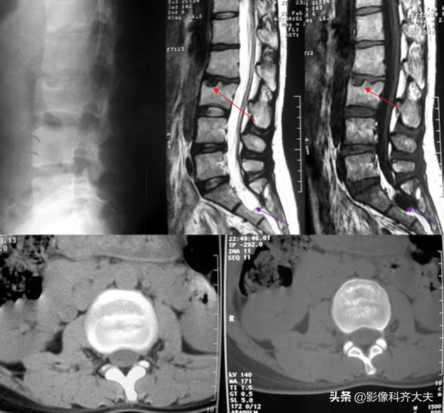 腰椎间盘突出最好的影像诊断方法,腰椎间盘突出的影像学检查