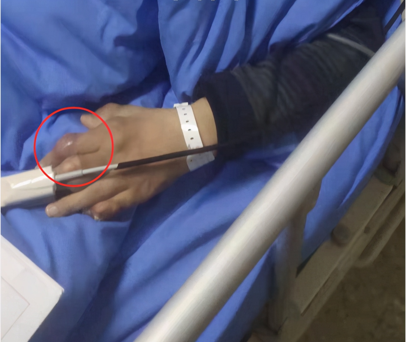 尿酸高急性肾衰竭,慢性肾衰竭尿酸高