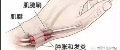弧刃针一次搞定腱鞘炎,腱鞘炎手腕疼一招搞定
