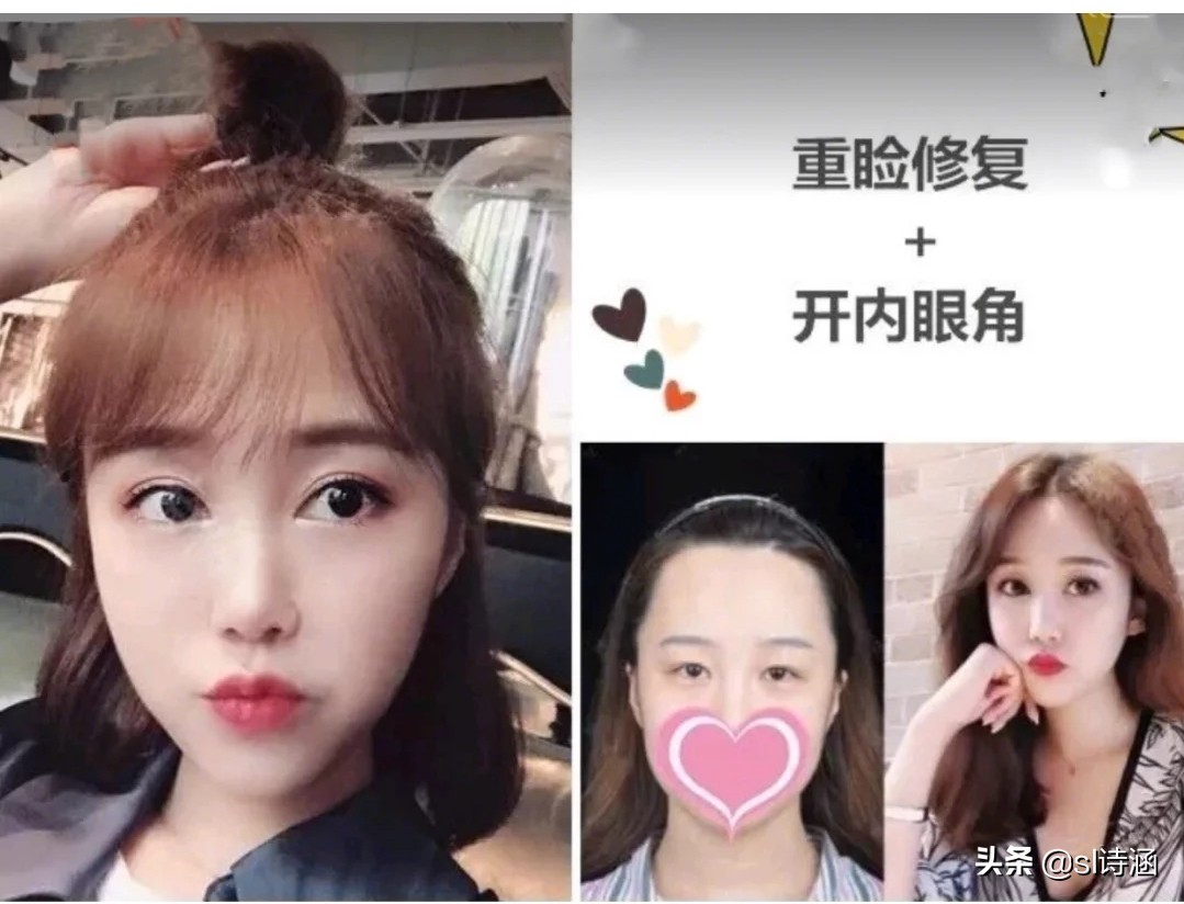 做完双眼皮之后有什么注意事项,做完双眼皮过后应该注意些什么