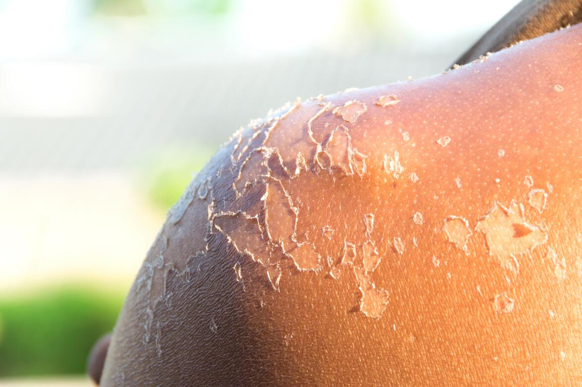 预防紫外线吃什么,吃什么抗皮肤癌