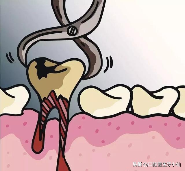 拔牙流血过程,拔牙后出血自我处理小妙招