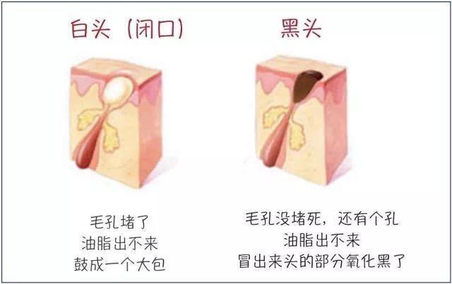 去黑头粉刺比较有效的方法,去黑头粉刺的最简单方法