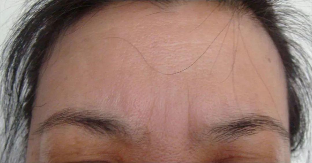 超声刀和热玛吉哪个提升效果好,超声刀和埋线提升哪个效果好