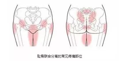 孕期耻骨痛得很严重怎么缓解,孕期耻骨痛怎么缓解