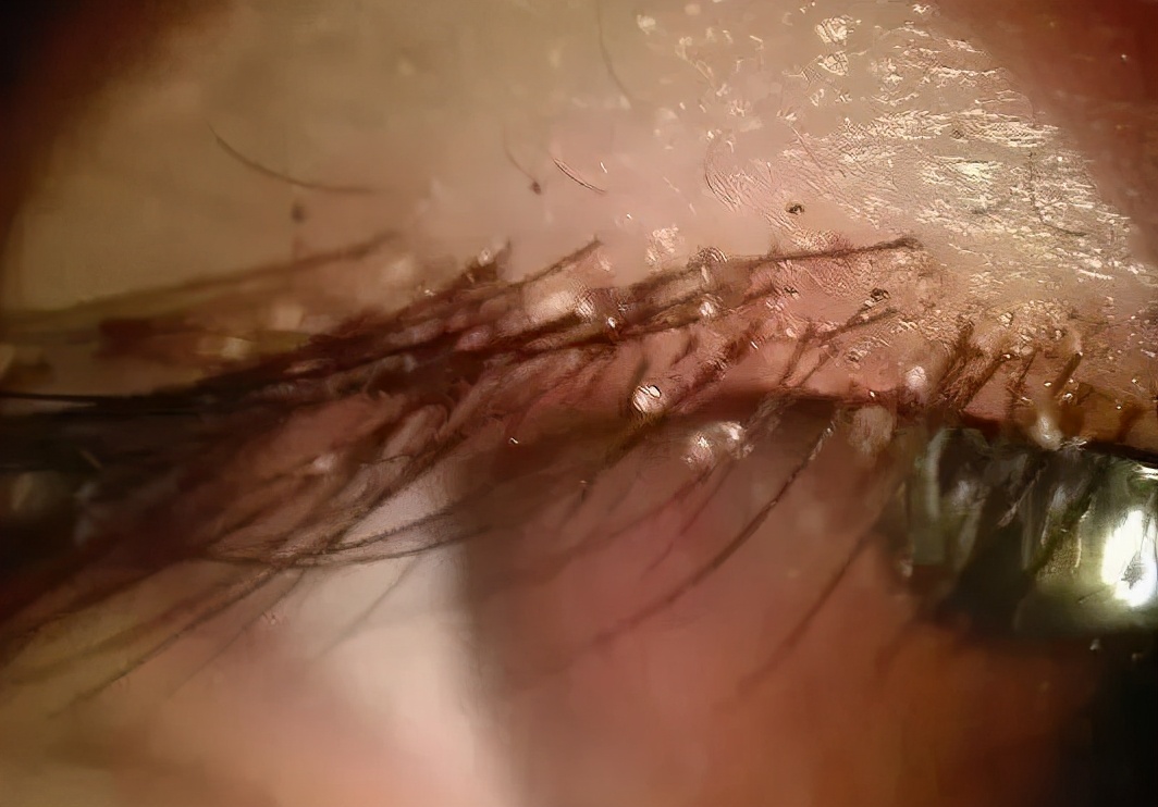 6岁孩子说眼睛痒眨眼怎么回事,小孩眼睛痒是有虫子吗