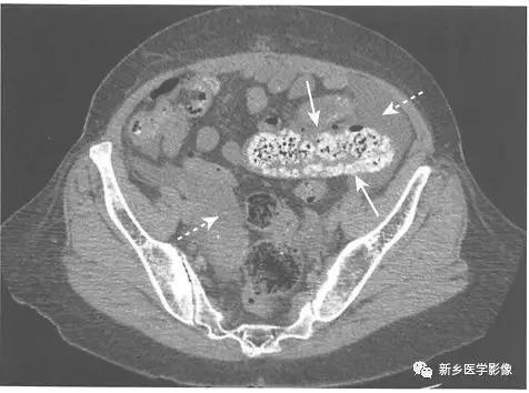 辨识肠梗阻,肠梗阻死亡前兆