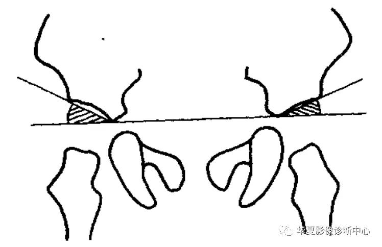 先天性髋关节脱位,先天性髋关节脱位属不属于残疾人