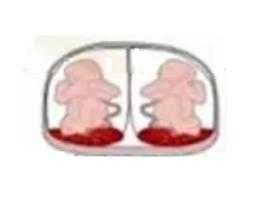 两个胎盘的双胞胎是同卵还是异卵,双胞胎一个胎盘有几条脐带