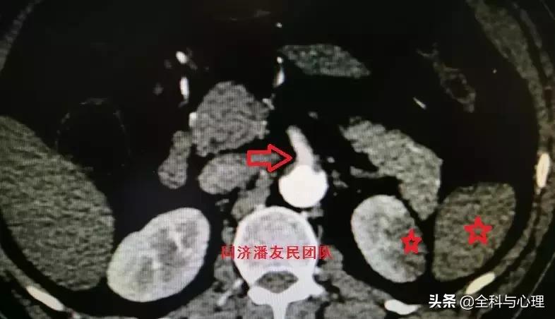 诊断主动脉夹层，千万别犯这种错误！