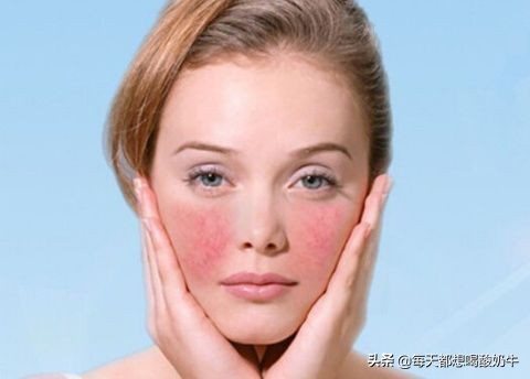 脸部泛红红血丝补水可以改善吗,脸部泛红怎么改善皮肤薄
