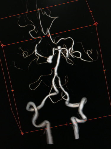 颅内巨大动脉瘤首选治疗技术,大脑中动脉动脉瘤闭塞的介入治疗