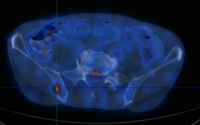 腰痛与肺癌有关吗,腰痛的厉害是得了肾癌吗