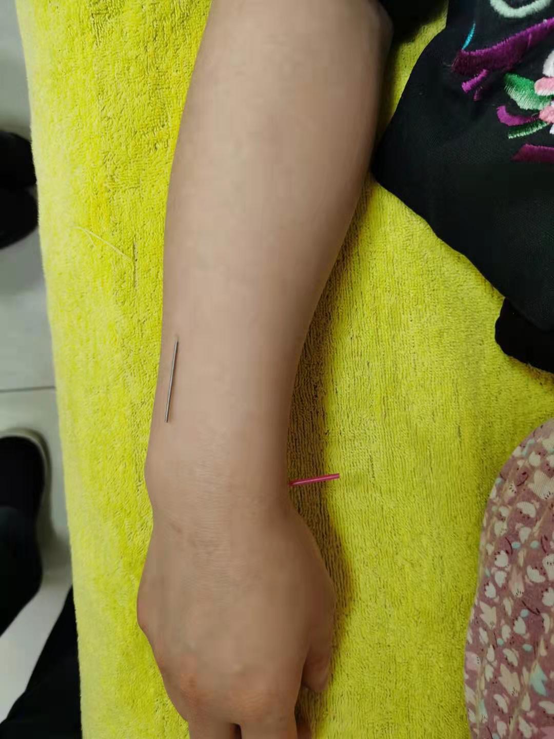 倪海厦失眠针灸案例,针灸治失眠的视频