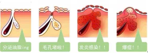 熬夜追《知否》后脸上狂暴痘？这些德国产品可以拯救你的脸！