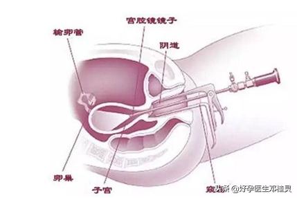 备孕科普:纵膈子宫有什么危害?能顺利怀孕生子吗?