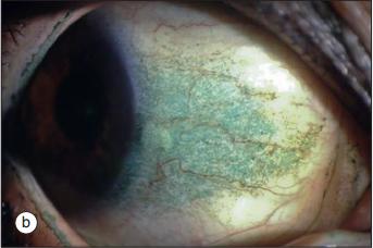 干燥综合征是什么样的症状,干燥综合征是什么样的