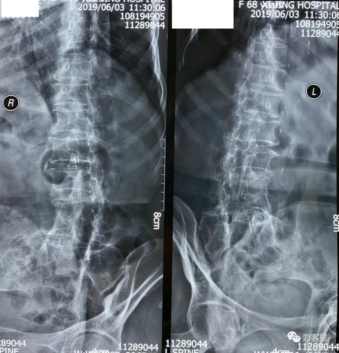 腰椎结核手术没有清病灶,腰椎结核术后不排气