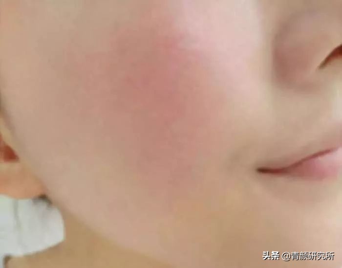 修复角质层薄红血丝敏感肌软膜,修复角质层薄红血丝敏感肌妙招