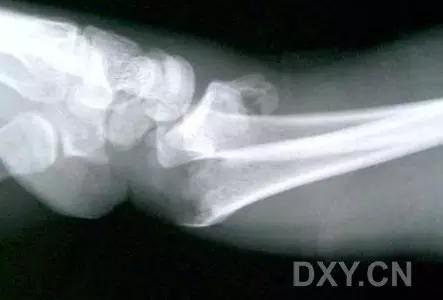 所有骨折都叫什么名字,骨折的名称有哪些