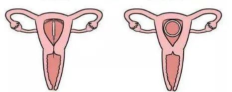 放环30年最近有点出血能取环吗,放环取环是什么意思