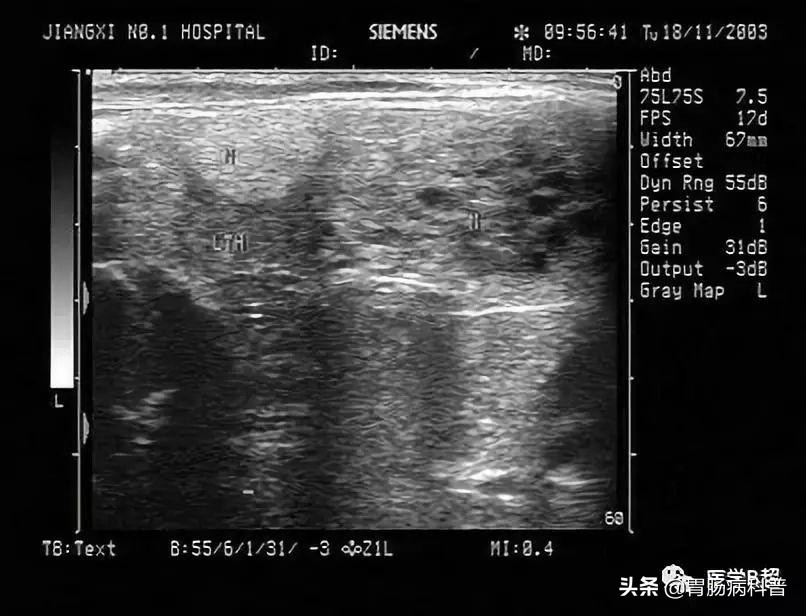 为什么医生都讲甲状腺结节不要紧,发现了甲状腺结节如何正确应对