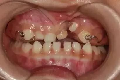 什么叫地包天怎么治疗,什么叫地包天能矫正吗