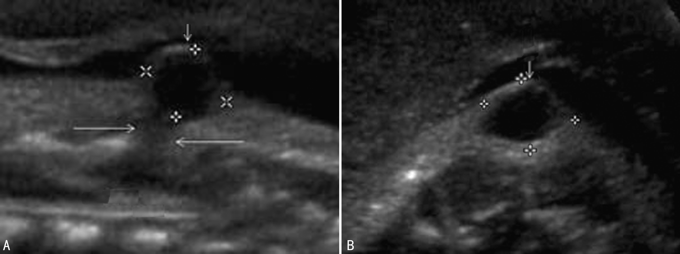 明明白白做超声25-5：胎儿神经管缺陷—脊柱裂