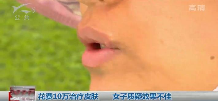 去除唇周黑在医院花多少钱,医院人员说不可以退款怎么办