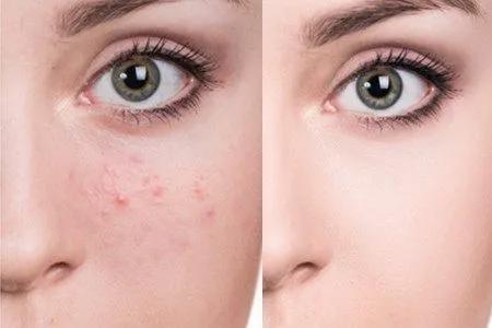 红痘印怎么医学处理,红痘印如何消除最快方法