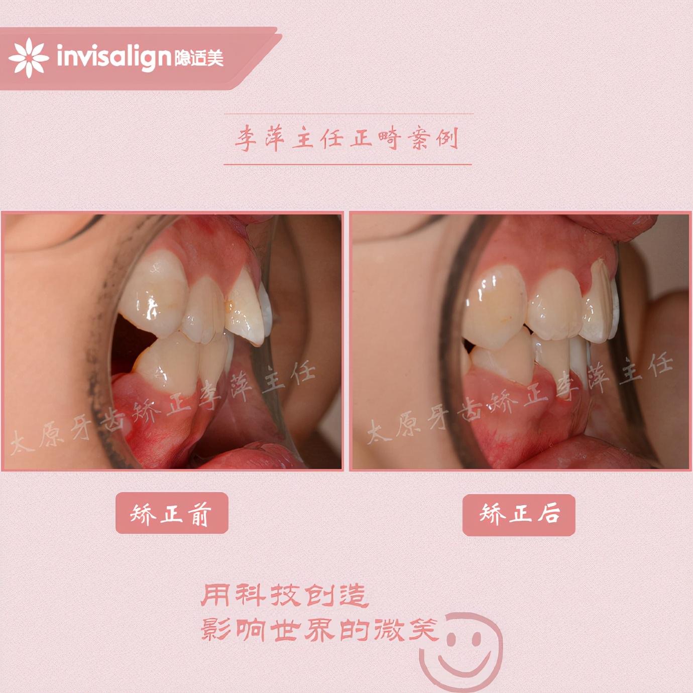 深覆合牙齿矫正不拔牙打骨钉,太原矫正牙齿需要做正颌吗