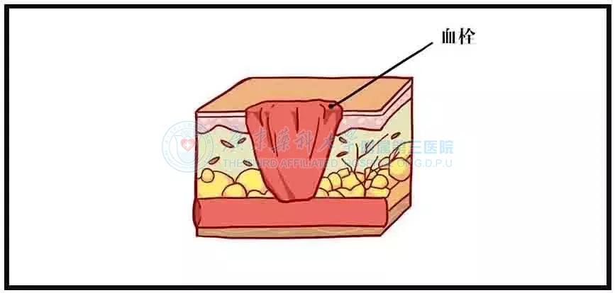 为什么伤好了会留疤,为什么一个小伤口愈合后都会留疤
