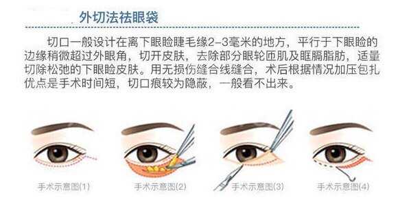 如何消除眼袋学生,如何消除眼袋男