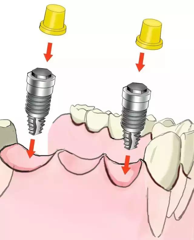 镶牙手绘图,镶牙图片过程
