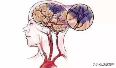 知名歌手得了可怕的心脏主动脉夹层,你了解吗