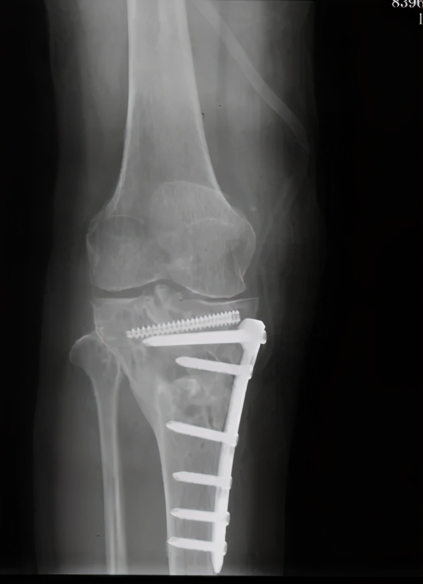 「病例精选」不用换关节，TCVO手术给您新“膝”望