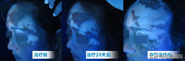 白癜风患者盲目用药的危害有哪些,白癜风不再发展是治好了吗