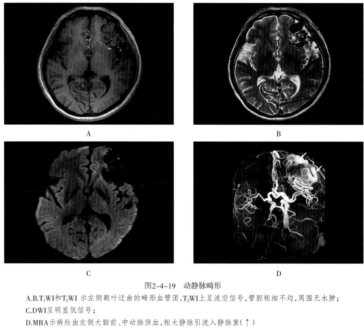 颅内血管周围间隙的影像鉴别,颅脑血管源性疾病影像诊断